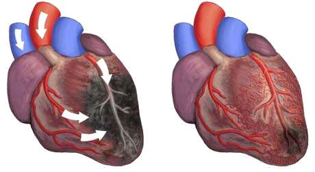 Non Surgical Heart Block Treatment Mumbai EECP Treatment